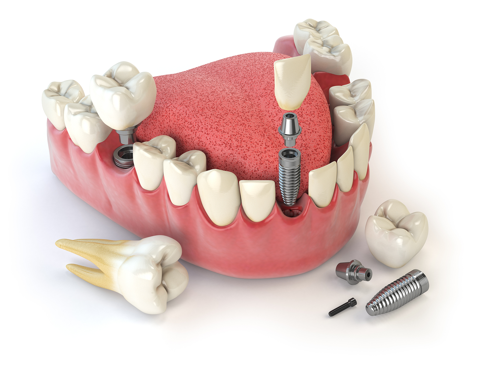 Implant Supported Dentures Implant Supported Dentures